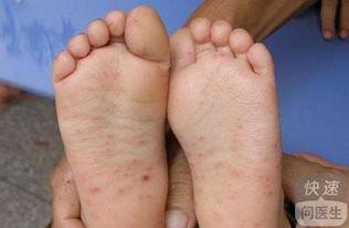 手足口可以吃瓜,夏日瓜果美味，健康防护不可少